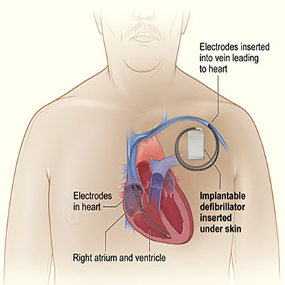 https://batrahealthcare.com/wp-content/uploads/2023/12/implantable-cardioverter-defibrillator-1.jpg