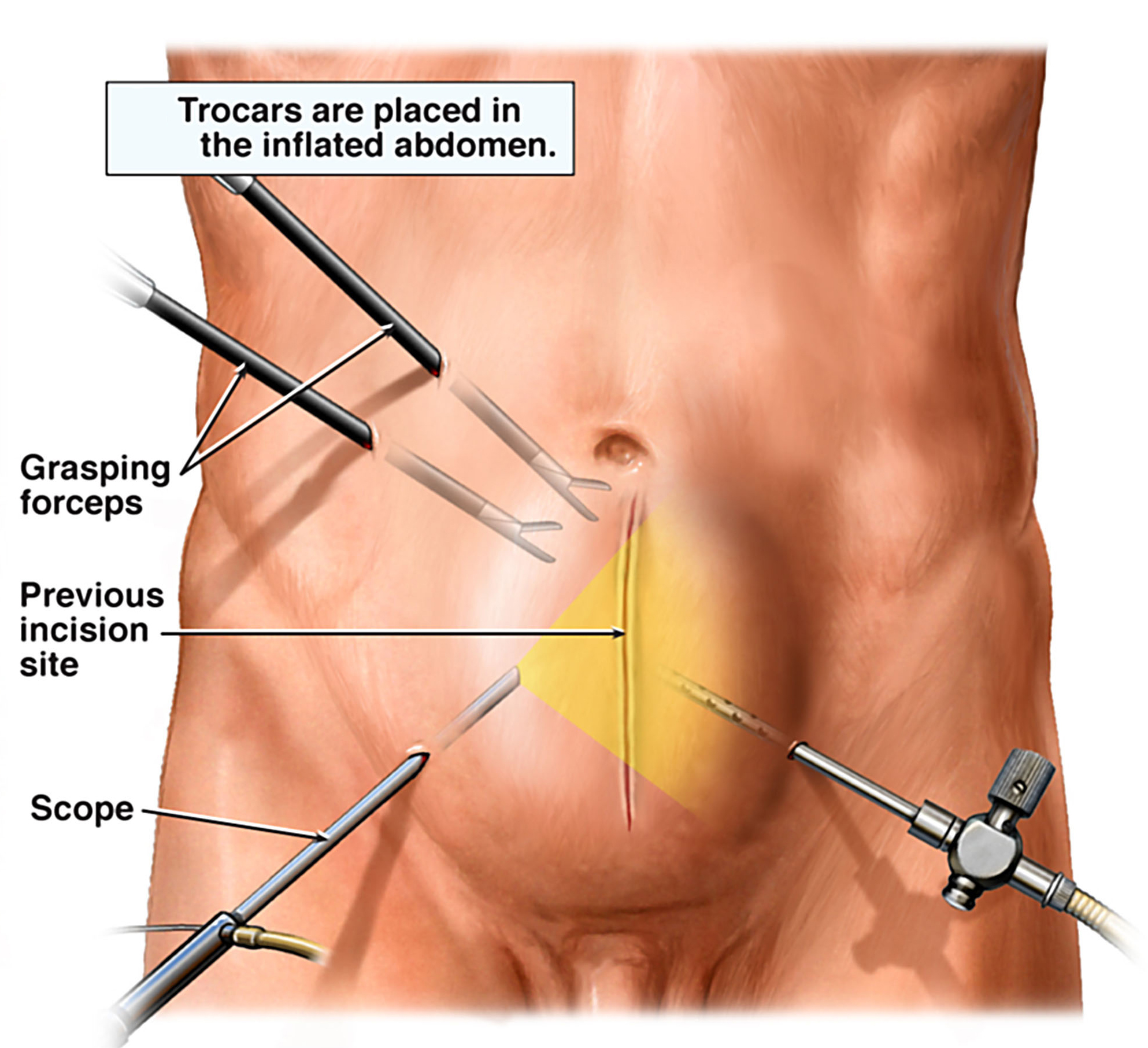 https://batrahealthcare.com/wp-content/uploads/2023/12/laparoscopy-hernia-repair.jpg