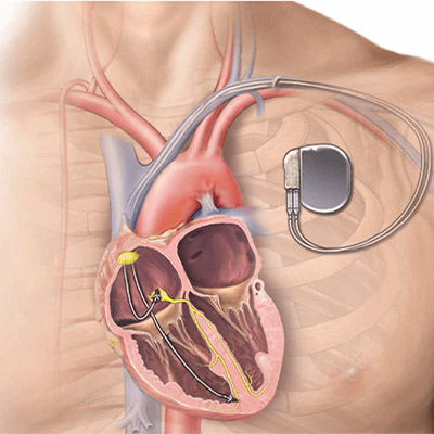 https://batrahealthcare.com/wp-content/uploads/2023/12/pacemaker1.jpg
