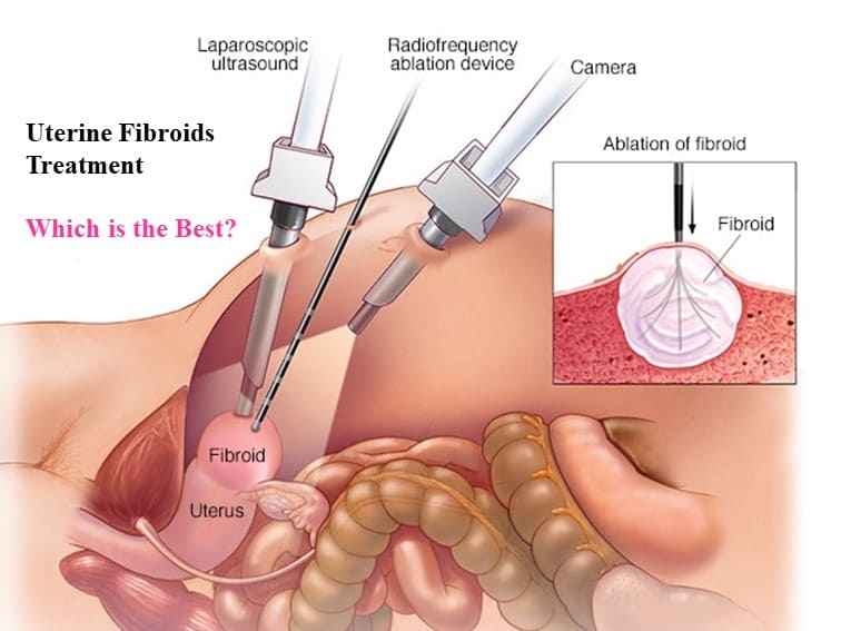 https://batrahealthcare.com/wp-content/uploads/2024/03/Best-fibroid-treatment-in-Hyderabad.jpg
