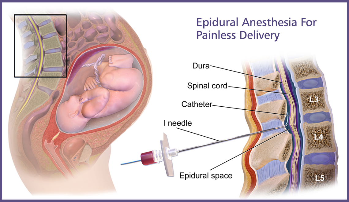 https://batrahealthcare.com/wp-content/uploads/2024/03/Epidural-Anesthesia-For-Painless-Delivery.png
