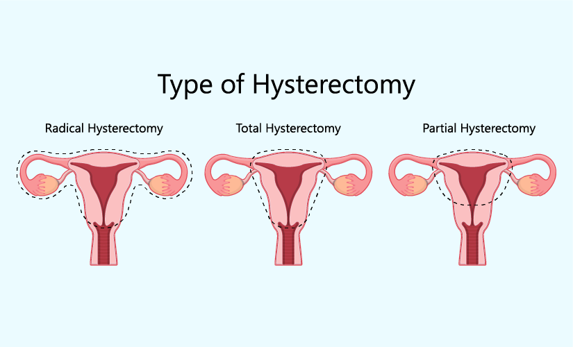 https://batrahealthcare.com/wp-content/uploads/2024/03/types-of-hysterectomy.png